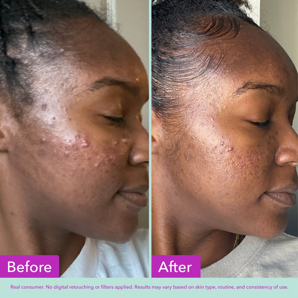 acne-foaming-cleanser-d4 zb_p.jpg