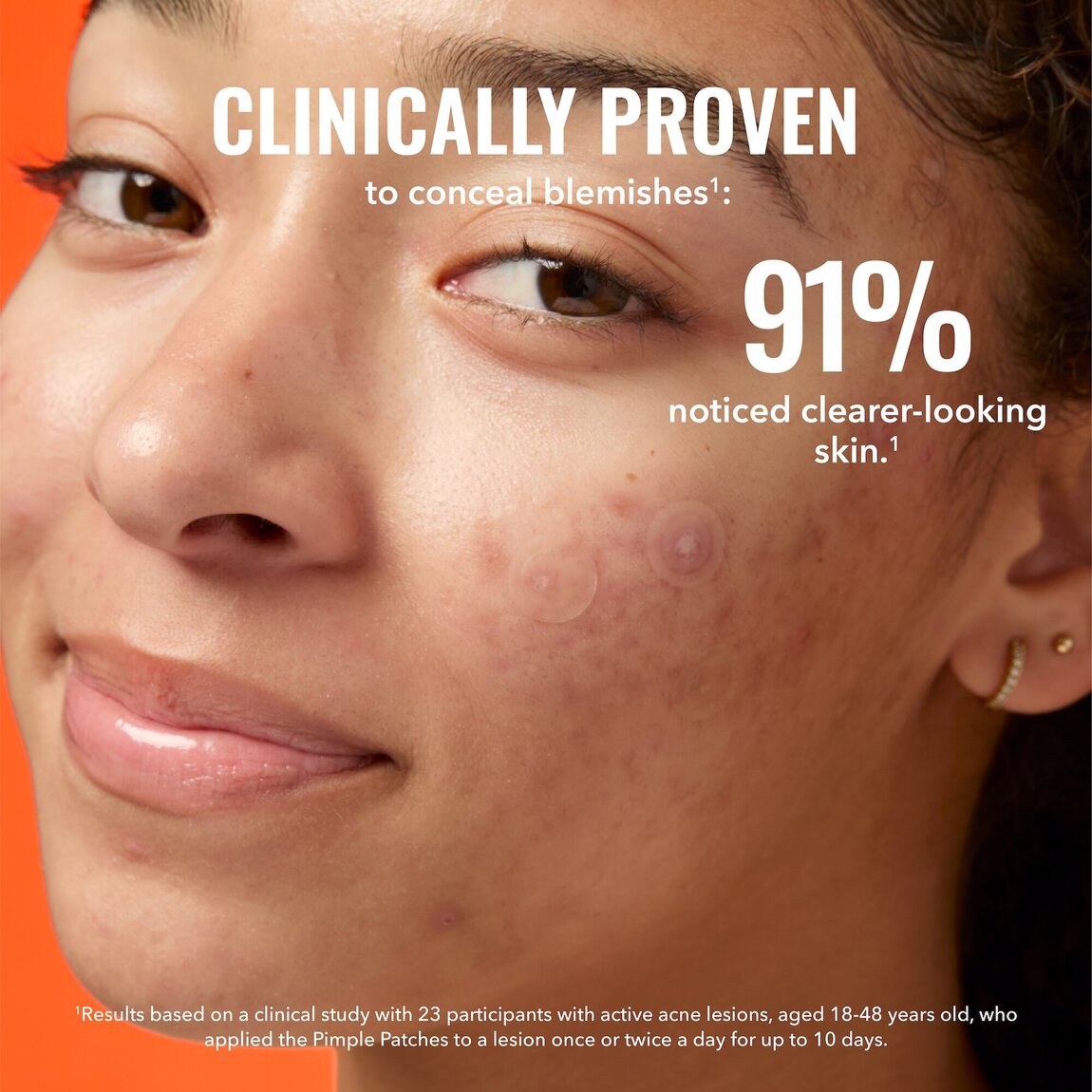 pimple-patches-t4 zb_p.jpg